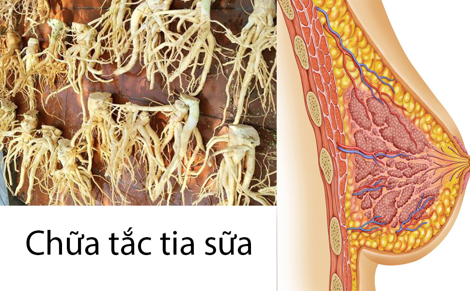 Chữa tắc tia sữa