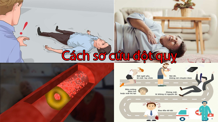 Cách sơ cứu đột quỵ