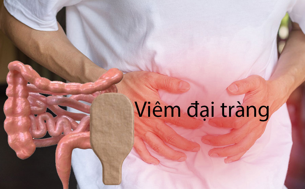 Viêm đại tràng