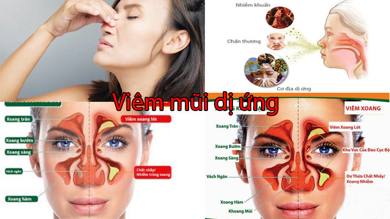 Viêm mũi dị ứng
