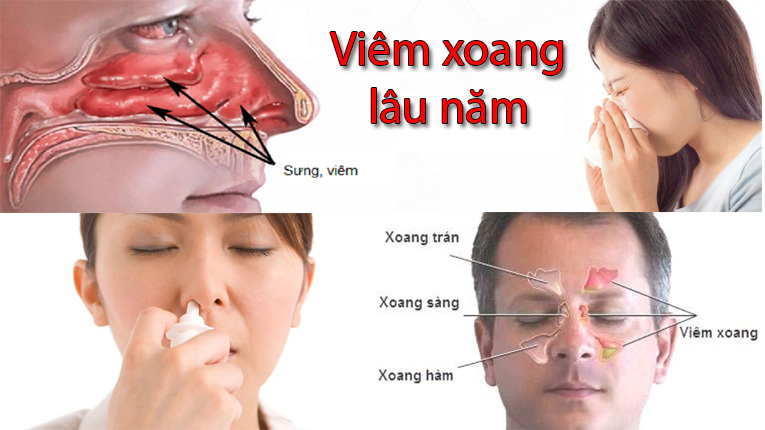Viêm mũi lâu năm