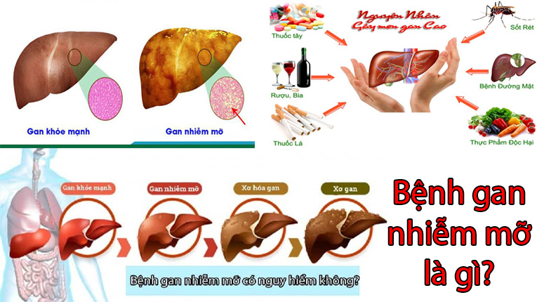 Gan nhiễm mỡ