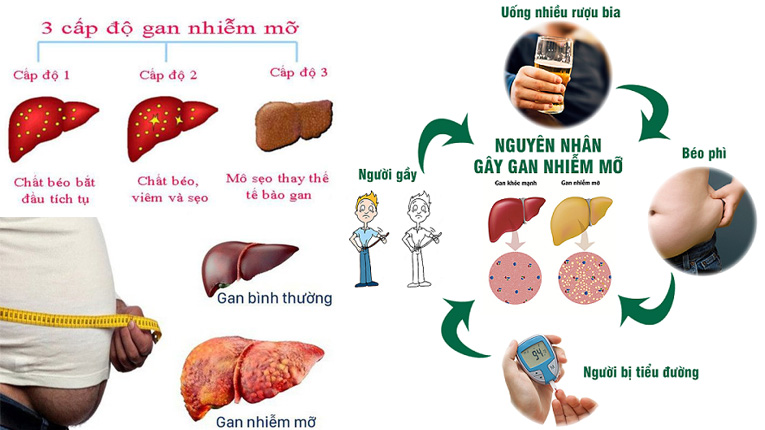 Gan nhiễm mỡ