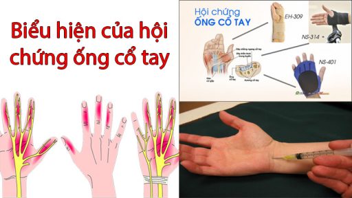 Biểu hiện của hội chứng ống cổ tay