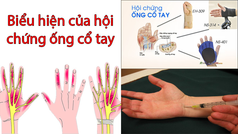 Biểu hiện của hội chứng ống cổ tay