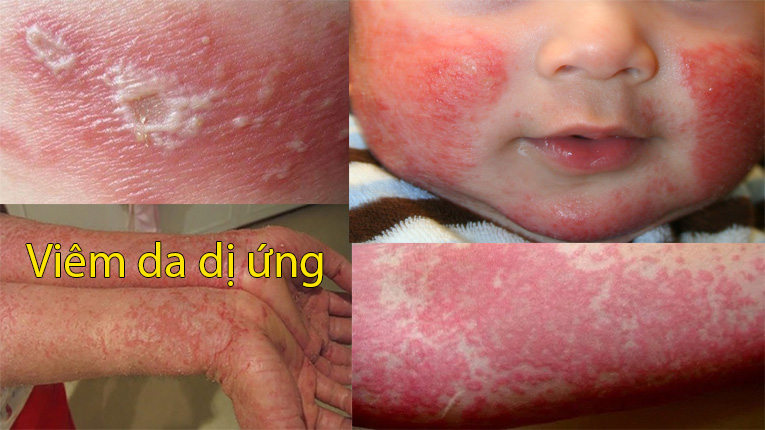 Viêm da dị ứng