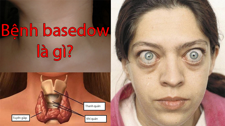 Bệnh basedow là gì?