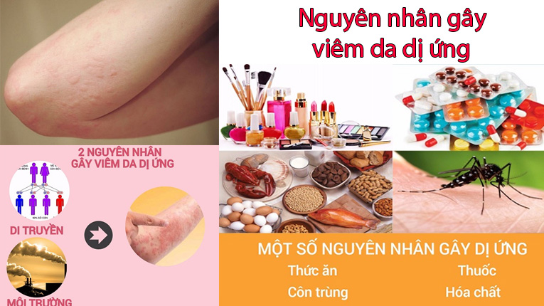 Nguyên nhân gây viêm da dị ứng