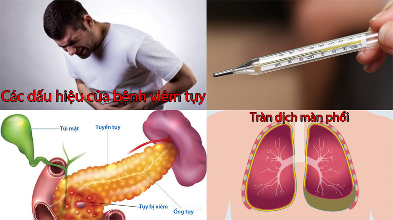 Các dấu hiệu của bệnh viêm tụy cấp