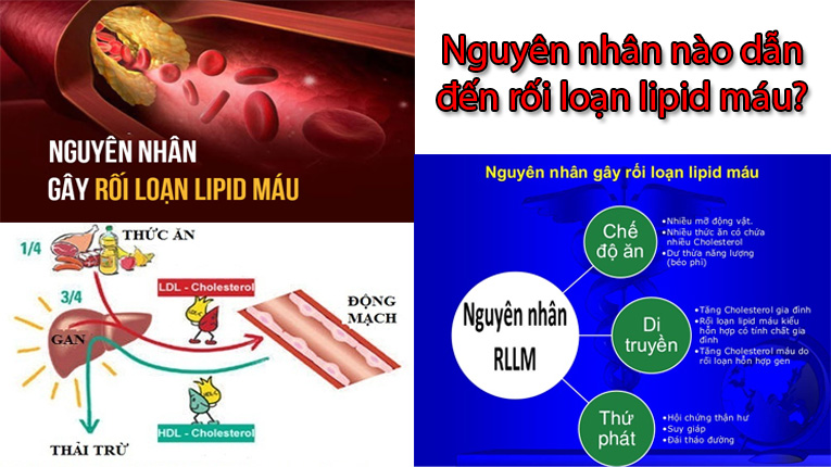 Nguyên nhân gây rối loạn mỡ máu