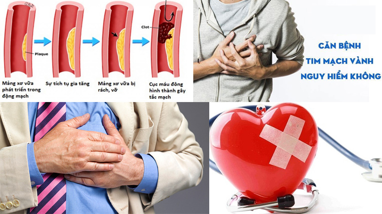 Bệnh mạch vành có nguy hiểm không?