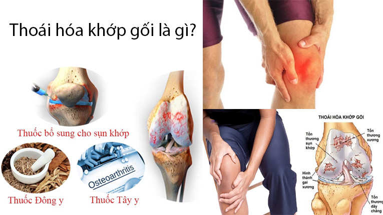 Thoái hóa khớp gối là gì?