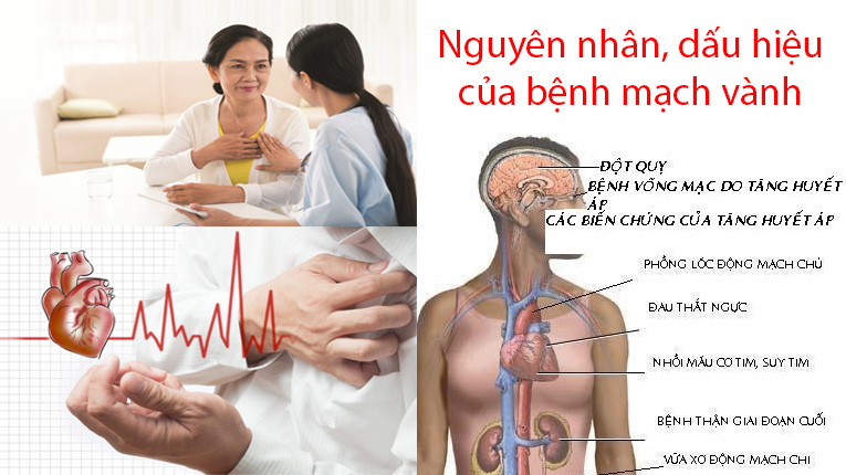 Nguyên nhân, dấu hiệu của bệnh mạch vành