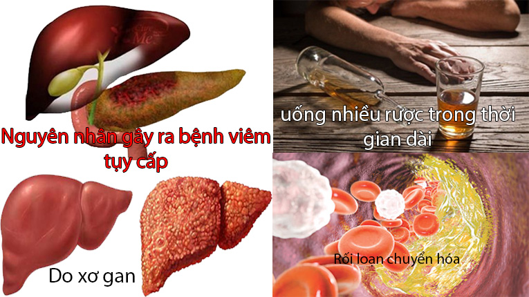 Nguyên nhân gây ra bệnh viêm tụy cấp
