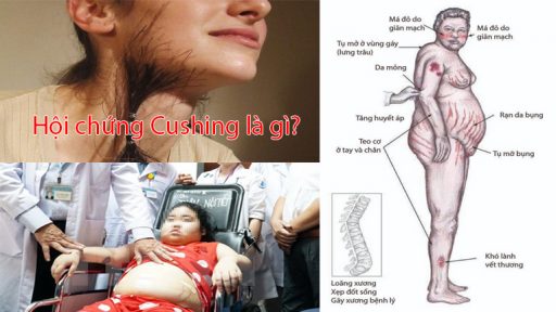 Hội chứng Cushing là gì?