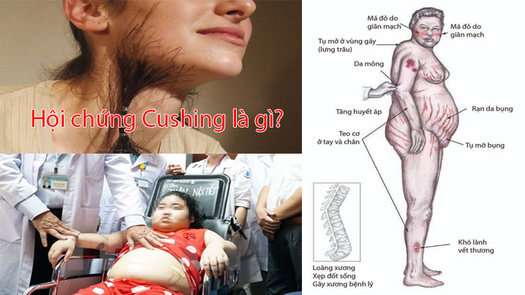Hội chứng Cushing là gì?