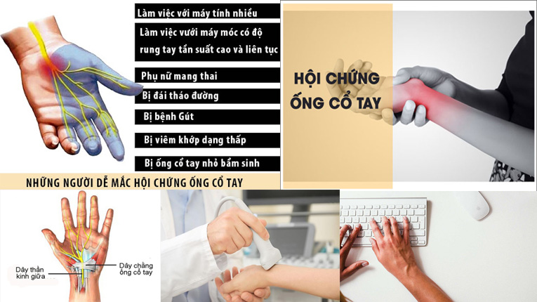 Nguyên nhân gây ra hội chứng ống cổ tay