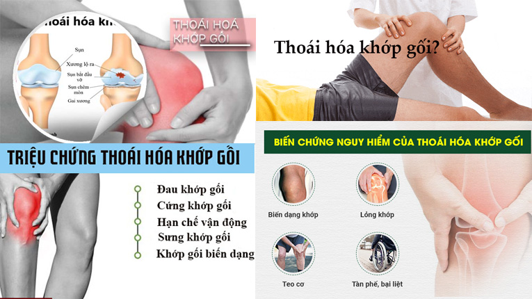 Biểu hiện của bệnh thoái hóa khớp gối