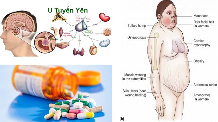 Nguyên nhân chủ yếu gây ra hội chứng Cushing