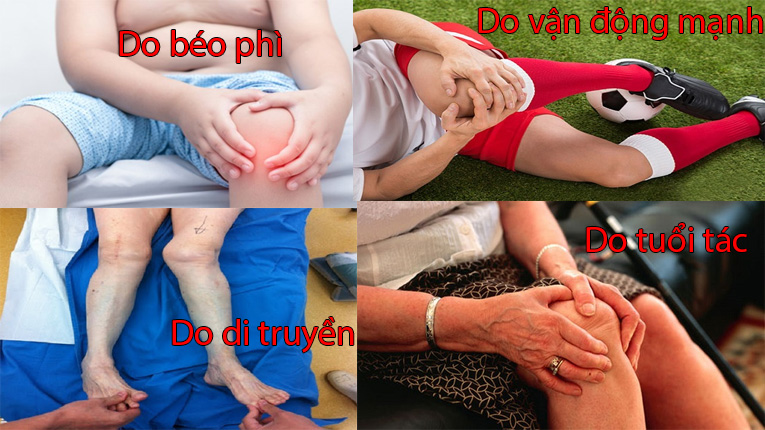 Nguyên nhân gây bệnh thoái hóa khớp gối