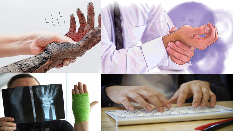 Nguyên nhân gây bệnh hội chứng ống cổ tay