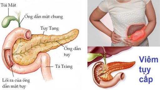 Viêm tụy cấp là gì?