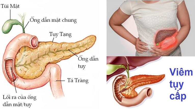 Viêm tụy cấp là gì?