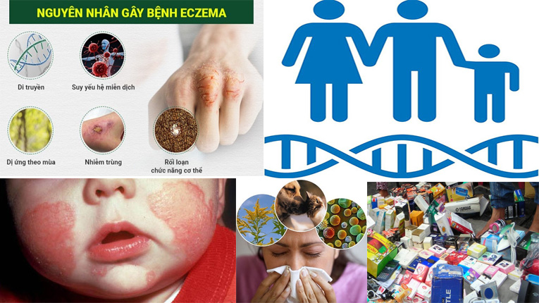Nguyên nhân gây ra bệnh chàm (eczema) là gì?