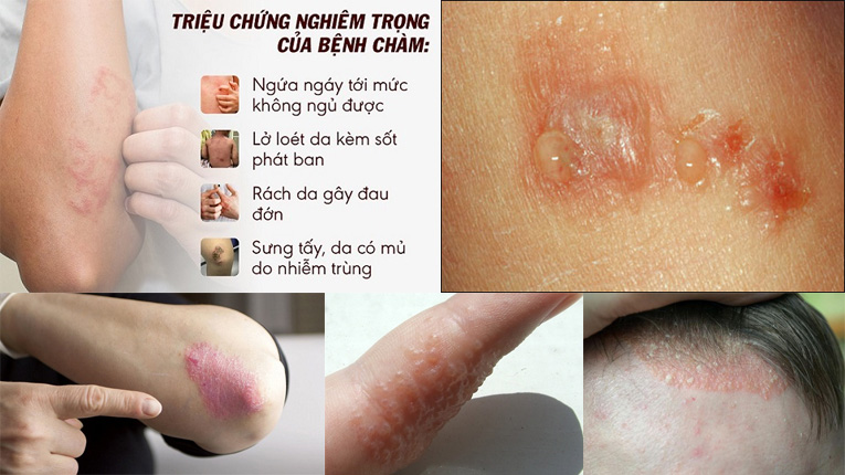 Nguyên nhân gây ra bệnh chàm (eczema) là gì?
