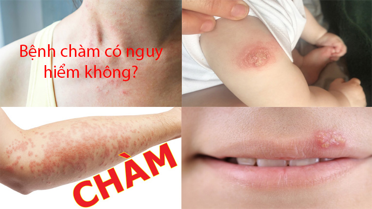 Bệnh chàm có nguy hiểm không?