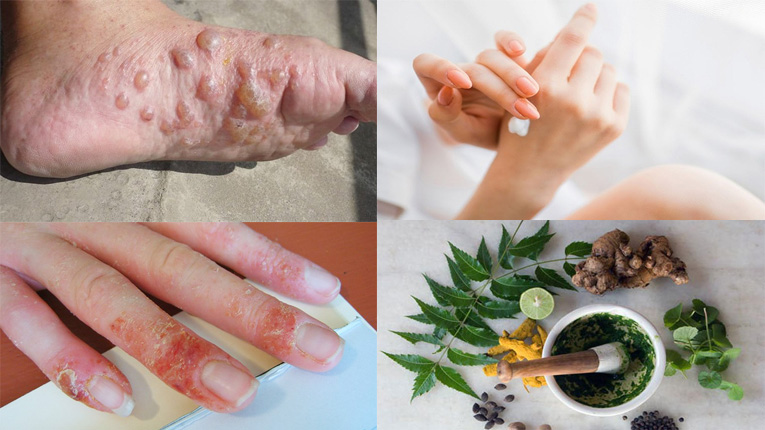Cách điều trị bệnh chàm