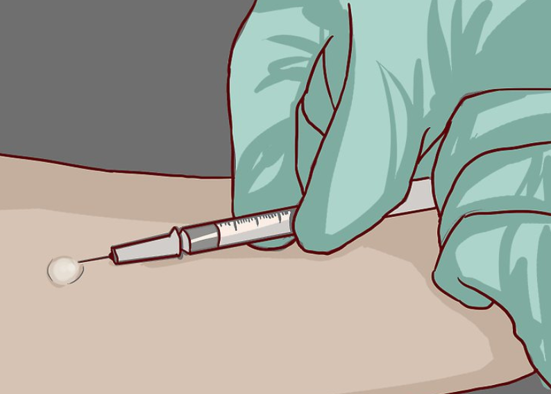 Xét nghiệm tiêm dưới da tuberculin