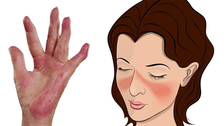 Bệnh lupus ban đỏ là gì?
