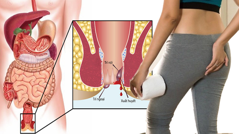 Bệnh trĩ có nguy hiểm không?