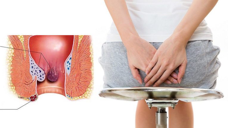 Dấu hiệu và nguyên nhân gây bệnh trĩ
