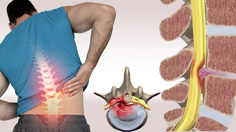 Thoát vị đĩa đệm là gì?