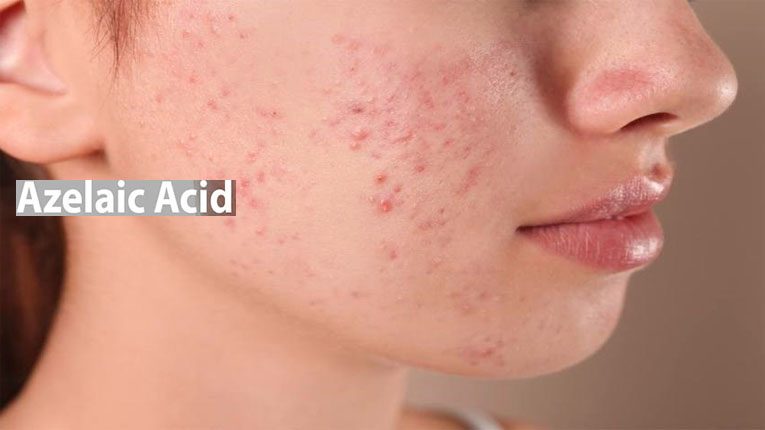 Azelaic acid có tác dụng gì Azelaic acid có tác dụng gì